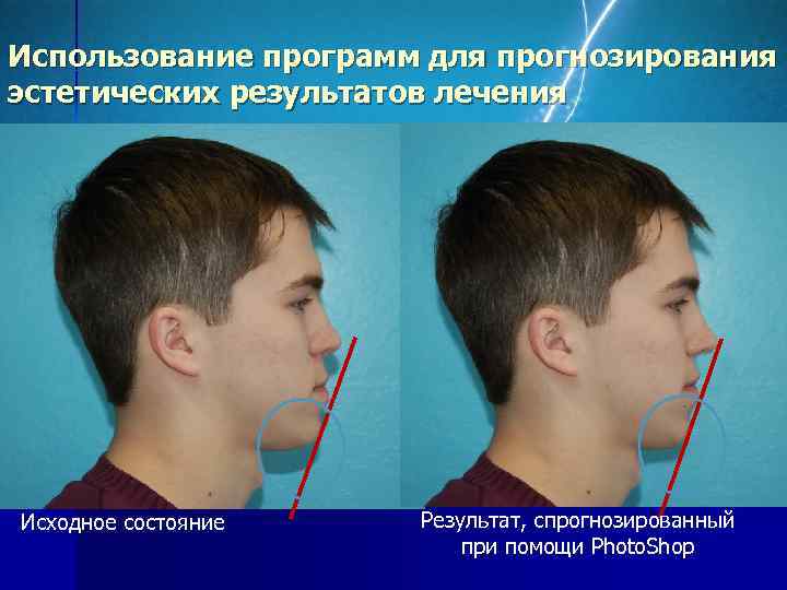 Использование программ для прогнозирования эстетических результатов лечения Исходное состояние  Результат, спрогнозированный  