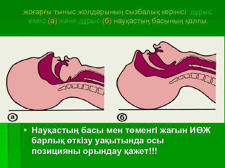   жоғарғы тыныс жолдарының сызбалық көрінісі дұрыс емес (а) және дұрыс (б) науқастың