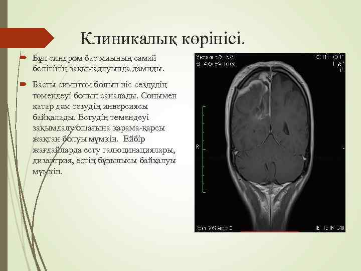    Клиникалық көрінісі. Бұл синдром бас миының самай  бөлігінің зақымадлуында дамиды.