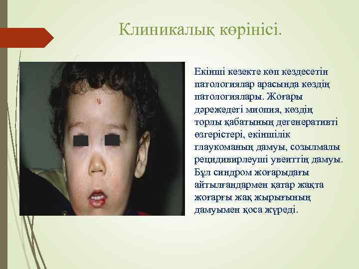 Клиникалық көрінісі.  Екінші кезекте көп кездесетін  патологиялар арасында көздің  патологиялары. Жоғары