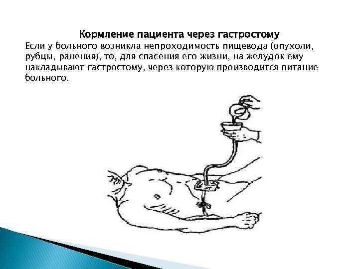    Кормление пациента через гастростому Если у больного возникла непроходимость пищевода (опухоли,