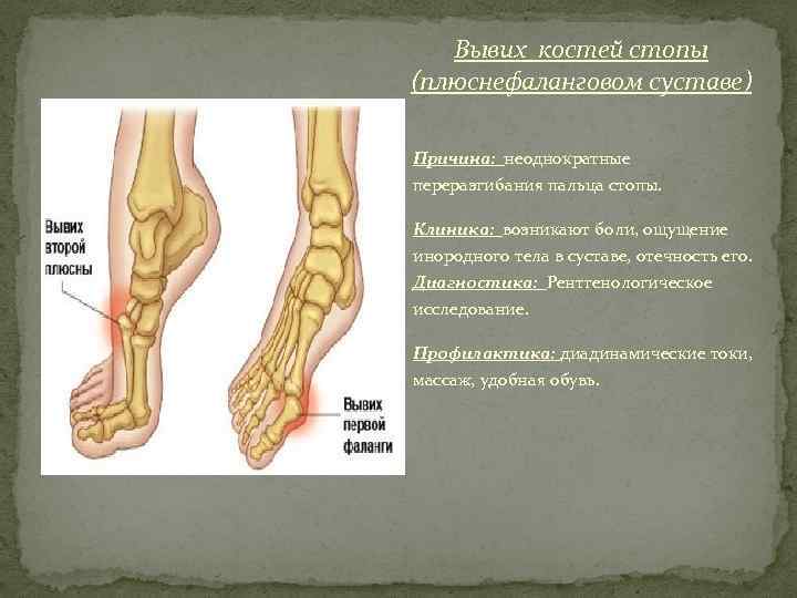 >  Вывих костей стопы (плюснефаланговом суставе) Причина: неоднократные переразгибания пальца стопы.  Клиника: