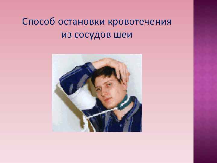 Способ остановки кровотечения из сосудов шеи Способ остановки кровотечения из сосудов шеи