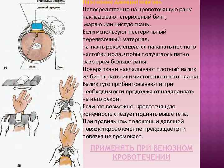 При венозном кровотечении накладывается давящая повязка