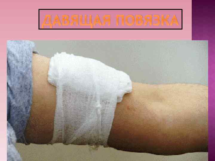 ДАВЯЩАЯ ПОВЯЗКА ДАВЯЩАЯ ПОВЯЗКА