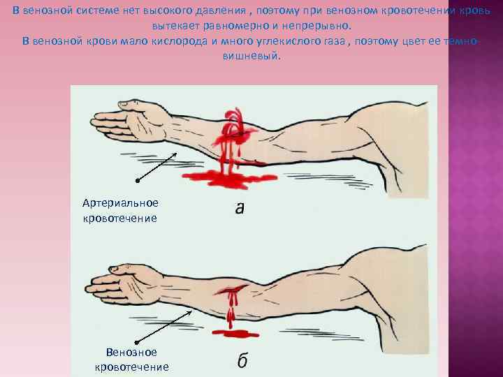 В венозной системе нет высокого давления , поэтому при венозном кровотечении кровь В венозной системе нет высокого давления , поэтому при венозном кровотечении кровь