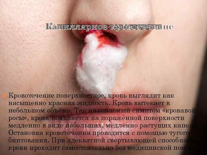    КАПИЛЛЯРНОЕ КРОВОТЕЧЕНИЕ   Кровотечение поверхностное, кровь выглядит как насыщенно красная