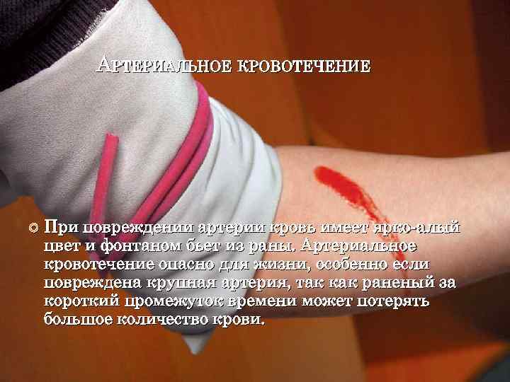    АРТЕРИАЛЬНОЕ КРОВОТЕЧЕНИЕ   При повреждении артерии кровь имеет ярко-алый цвет
