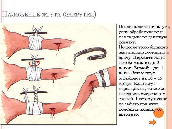 НАЛОЖЕНИЕ ЖГУТА (ЗАКРУТКИ)     После наложения жгута,    