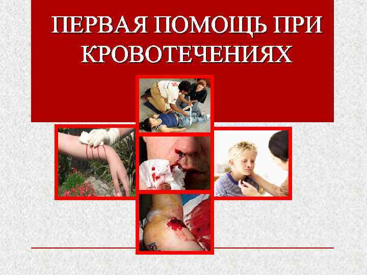 ПЕРВАЯ ПОМОЩЬ ПРИ  КРОВОТЕЧЕНИЯХ 