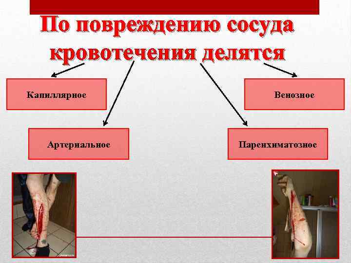  По повреждению сосуда  кровотечения делятся Капиллярное   Венозное  Артериальное 