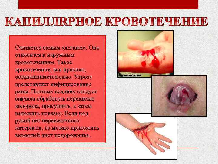 Считается самым «легким» . Оно относится к наружным кровотечениям. Такое кровотечение, как правило, останавливается