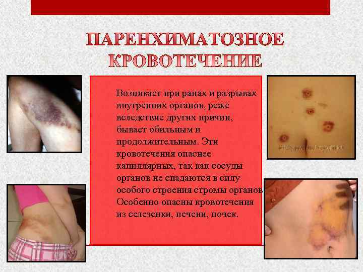 Возникает при ранах и разрывах внутренних органов, реже вследствие других причин, бывает обильным и