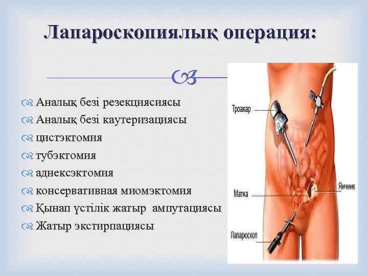   Лапароскопиялық операция:      Аналық безі резекциясиясы  Аналық