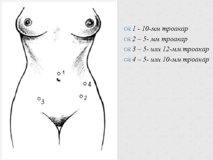  1 - 10 -мм троакар  2 – 5 - мм троакар 