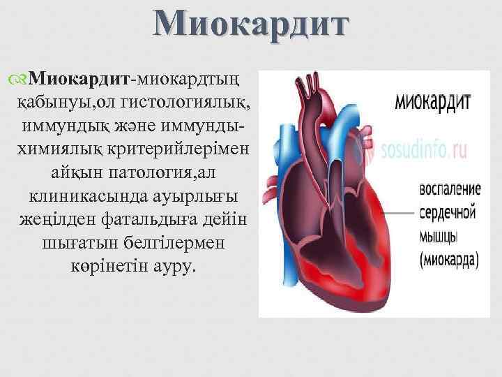     Миокардит-миокардтың қабынуы, ол гистологиялық,  иммундық және иммунды- химиялық критерийлерімен