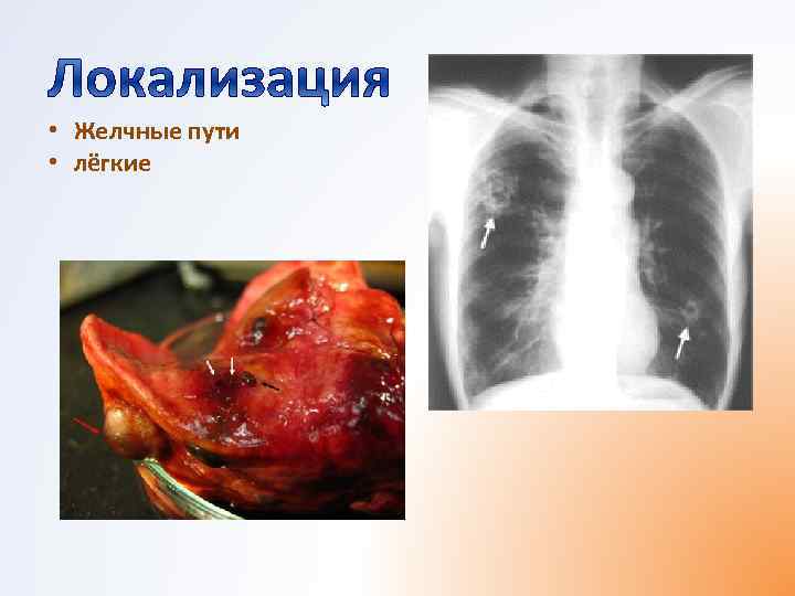  • Желчные пути • лёгкие 