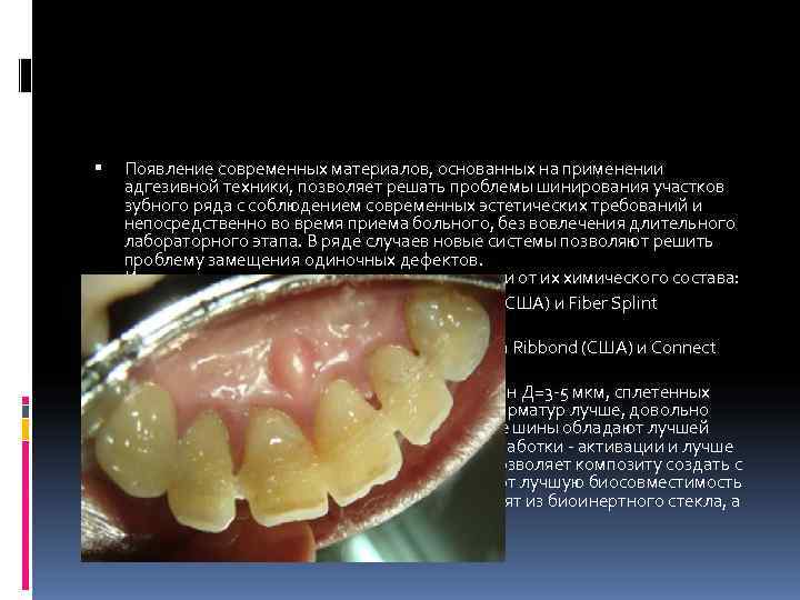   Появление современных материалов, основанных на применении адгезивной техники, позволяет решать проблемы шинирования