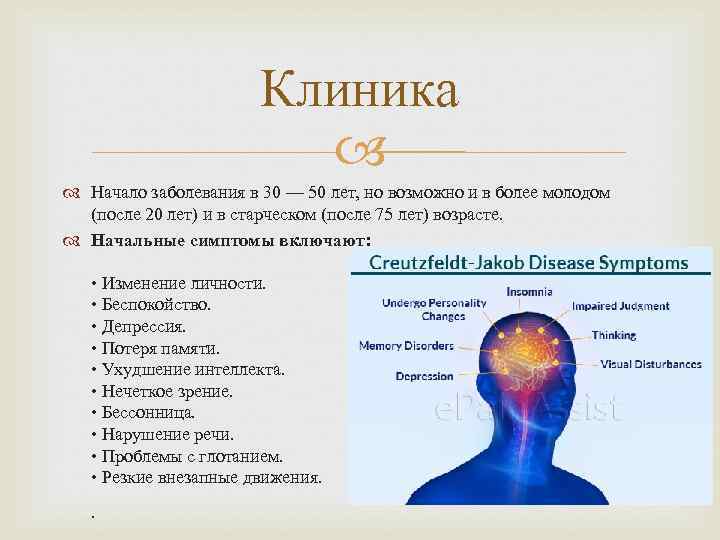     Клиника     Начало заболевания в 30 —