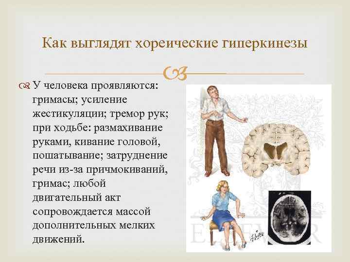   Как выглядят хореические гиперкинезы  У человека проявляются:    