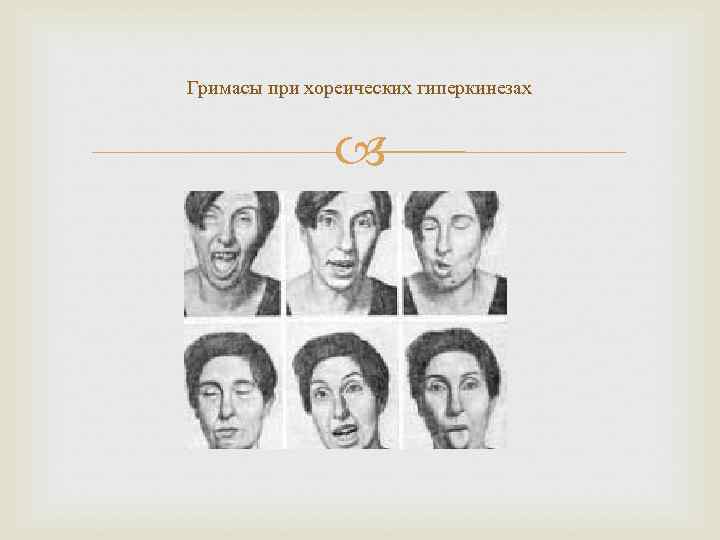 Гримасы при хореических гиперкинезах    