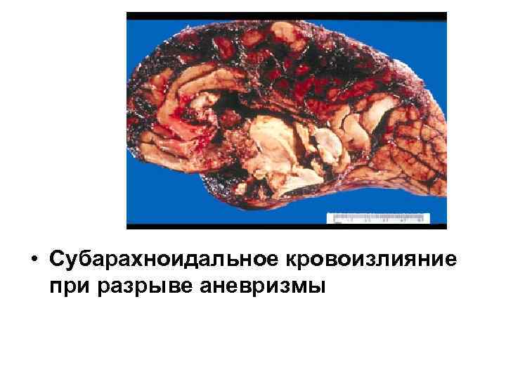  • Субарахноидальное кровоизлияние  при разрыве аневризмы 