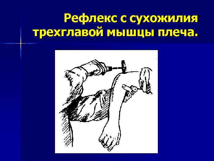  Рефлекс с сухожилия трехглавой мышцы плеча. 