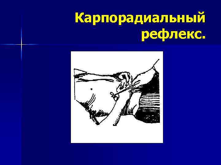 Карпорадиальный   рефлекс. 