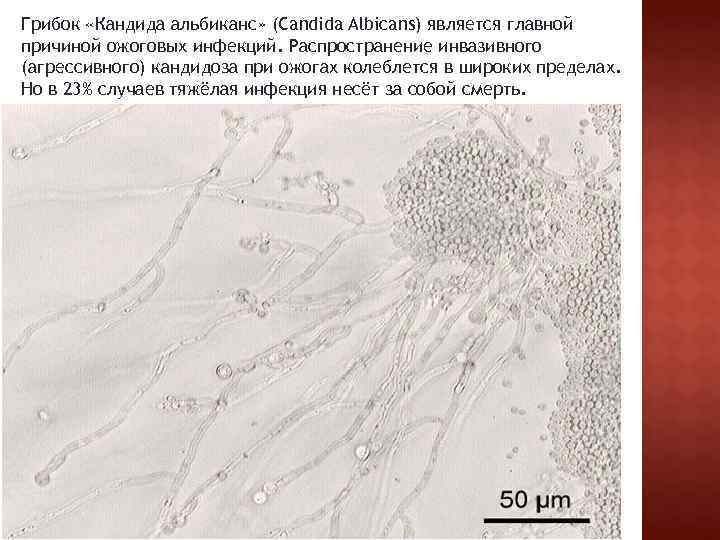 Грибок «Кандида альбиканс» (Candida Albicans) является главной причиной ожоговых инфекций. Распространение инвазивного (агрессивного) кандидоза