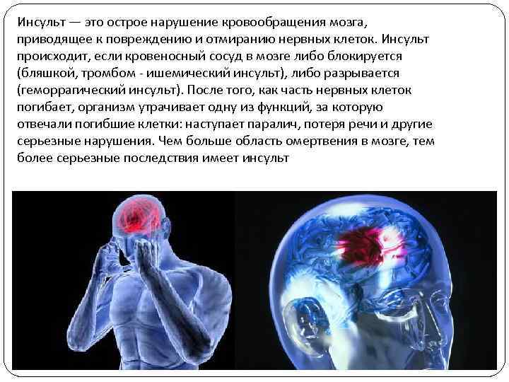 Инсульт — это острое нарушение кровообращения мозга,  приводящее к повреждению и отмиранию нервных
