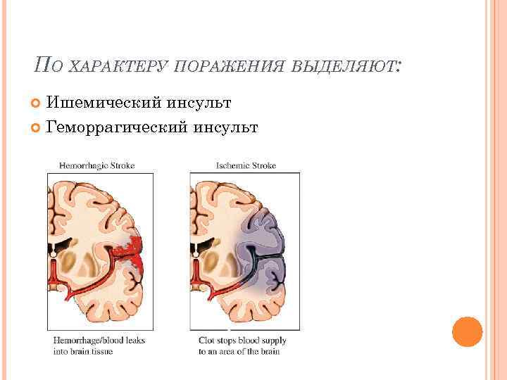 Инсульт презентация 8 класс