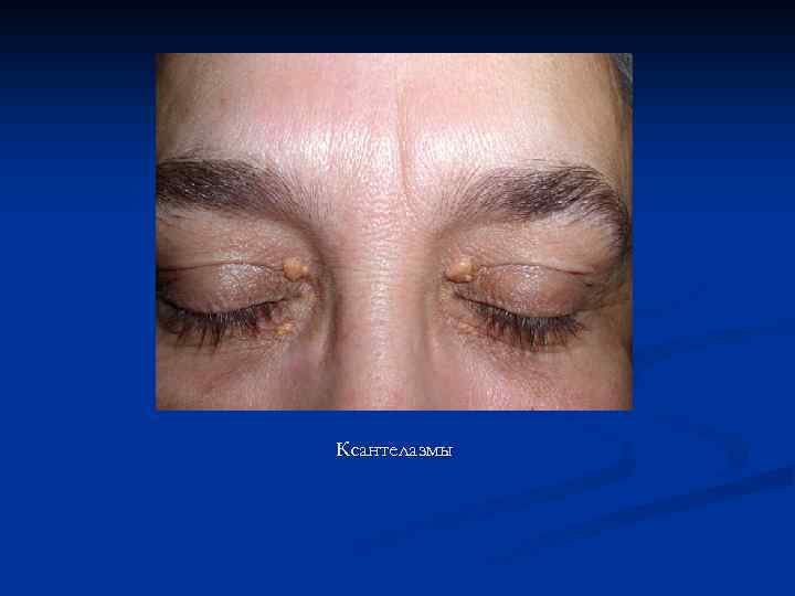 Ксантелазмы 