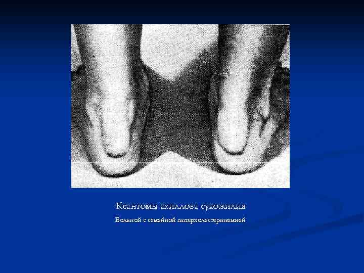 Ксантомы ахиллова сухожилия Больной с семейной гиперхолестеринемией 