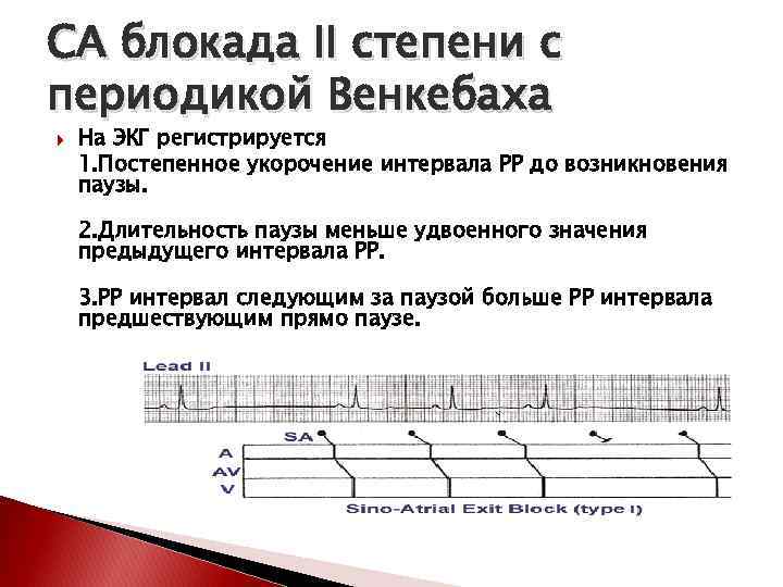 СА блокада II степени с периодикой Венкебаха На ЭКГ регистрируется 1. Постепенное укорочение интервала