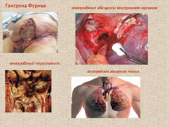 Гангрена Фурнье анаэробные абсцессы внутренних органов анаэробный перитонит. анаэробная гангрена легких. 