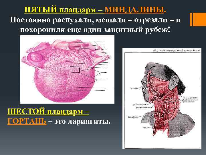 ПЯТЫЙ плацдарм – МИНДАЛИНЫ. Постоянно распухали, мешали – отрезали – и похоронили еще один