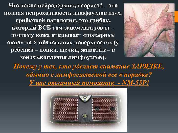 Что такое нейродермит, псориаз? – это полная непроходимость лимфоузлов из-за грибковой патологии, это грибок,