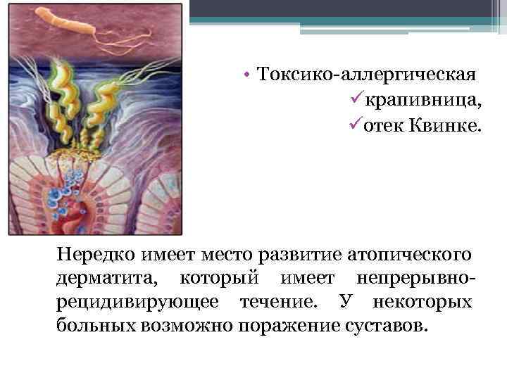  • Токсико-аллергическая üкрапивница, üотек Квинке. Нередко имеет место развитие атопического дерматита, который имеет