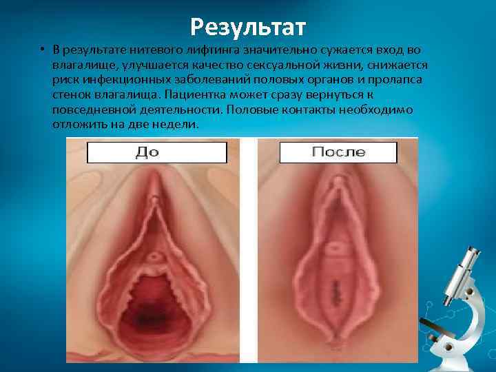 Результат • В результате нитевого лифтинга значительно сужается вход во влагалище, улучшается качество сексуальной