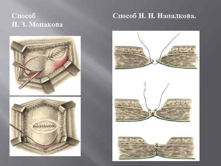 Способ Н. З. Монакова Способ Н. И. Напалкова. 