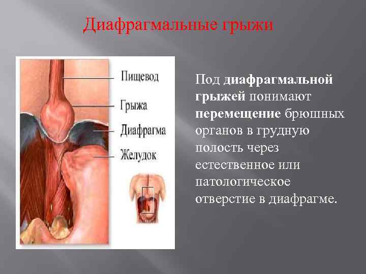 Диафрагмальные грыжи Под диафрагмальной грыжей понимают перемещение брюшных органов в грудную полость через естественное