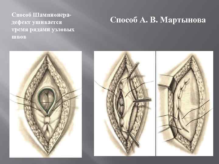 Способ Шампионерадефект ушивается тремя рядами узловых швов Способ А. В. Мартынова 