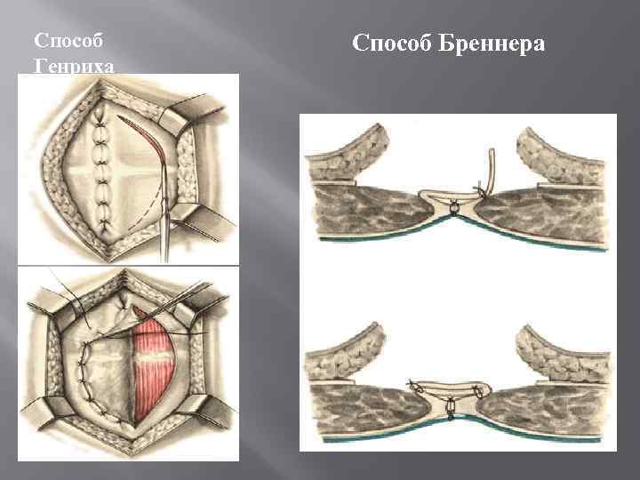 Способ Генриха Способ Бреннера 