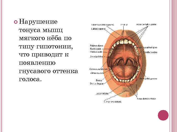  Нарушение тонуса мышц мягкого нёба по типу гипотонии, что приводит к появлению гнусавого