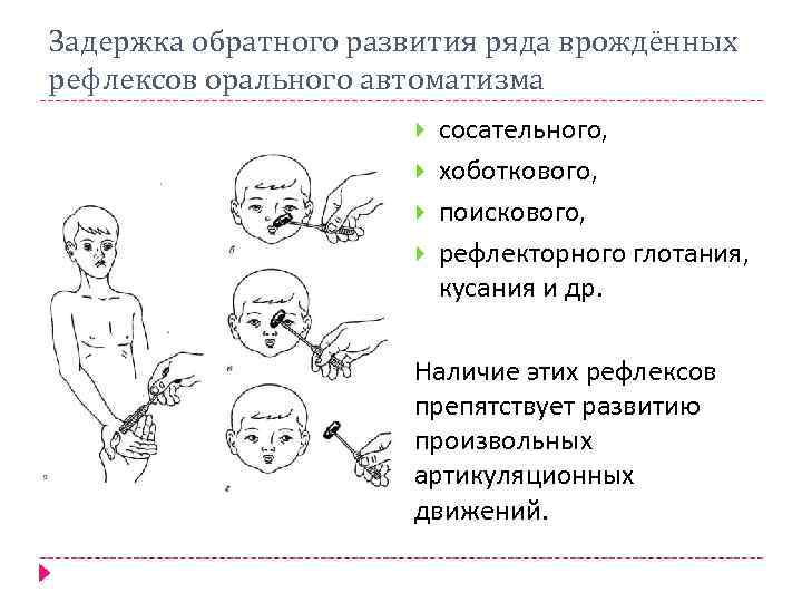 Задержка обратного развития ряда врождённых рефлексов орального автоматизма сосательного, хоботкового, поискового, рефлекторного глотания, кусания