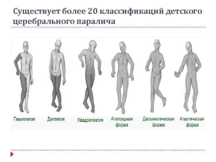 Существует более 20 классификаций детского церебрального паралича 