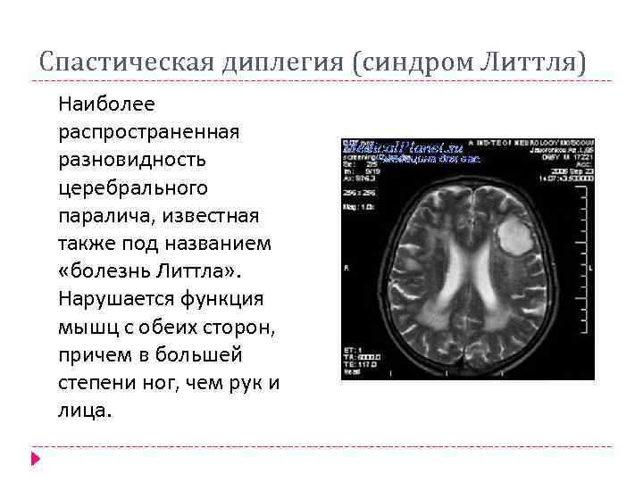 Спастическая диплегия (синдром Литтля) Наиболее распространенная разновидность церебрального паралича, известная также под названием «болезнь