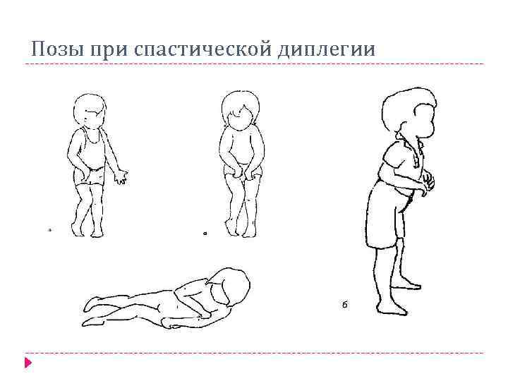 Позы при спастической диплегии 