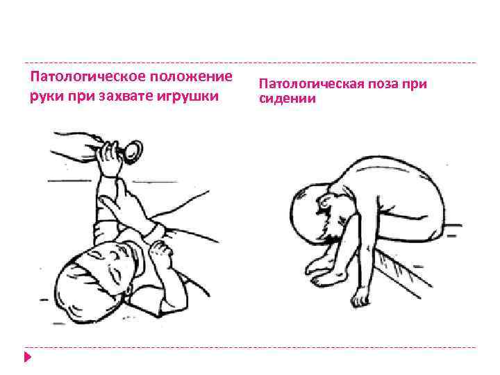 Патологическое положение руки при захвате игрушки Патологическая поза при сидении 