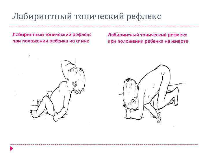 Лабиринтный тонический рефлекс при положении ребенка на спине Лабиринтный тонический рефлекс при положении ребенка